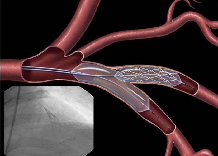 Спонтанная диссекция коронарной артерии (SCAD)
